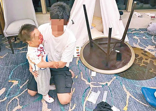 兩歲童碰翻圓桌險毀容  酒店拒認責