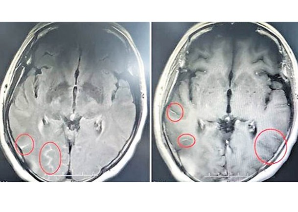 疑接觸家禽  婦頭痛揭染腦膜炎