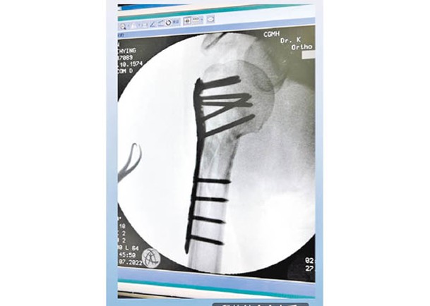 林志穎上載X光照片，不少粉絲大表心痛。