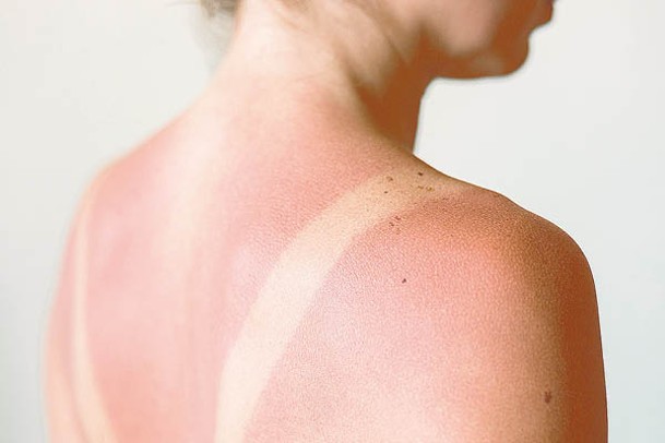 暴曬後皮膚容易出現紅腫、灼熱等情況。
