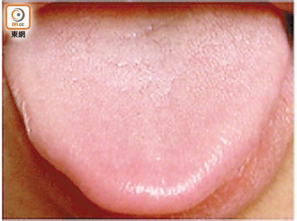 正常健康狀態的舌頭色淡紅、苔薄白。