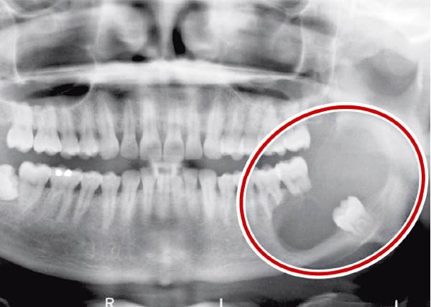阻生智慧齒亦有可能引致含齒囊腫（紅圈示）。