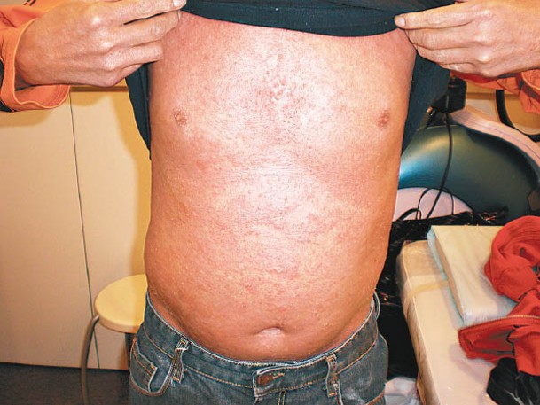 紅皮症通常由濕疹、牛皮癬等皮膚病引起。