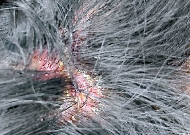 部分銀屑病患者的皮屑會生長在頭皮上，更因此受到歧視。