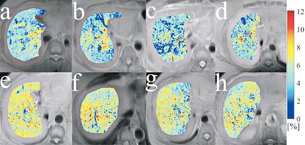 新技術透過分析MRI影像，顯示有否肝纖維化。圖a至d是沒有纖維化，e至h則是有纖維化。