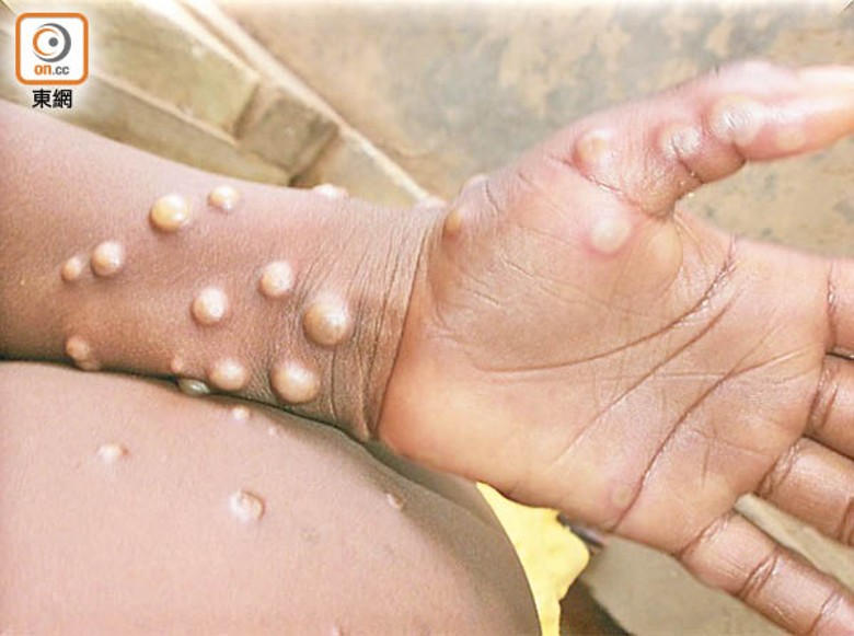 衞生署指會密切留意歐洲猴痘爆發情況。