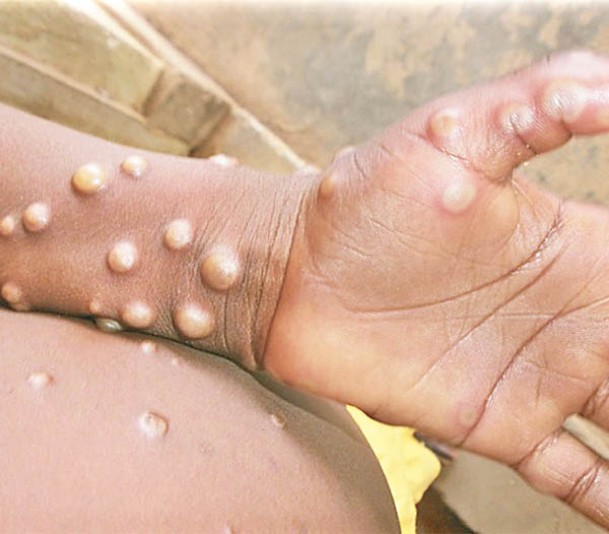 患者受感染後出現的水泡體積較水豆大，嚴重者會流膿。