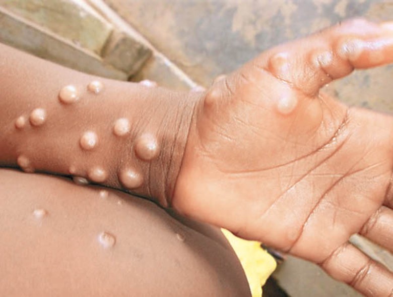 猴痘近期已蔓延至亞洲。