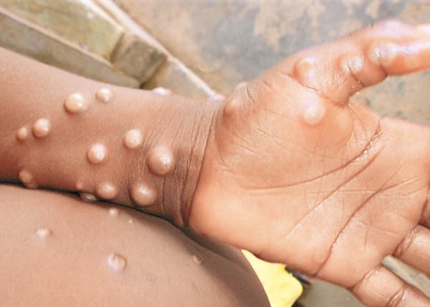 猴痘近期已蔓延至亞洲。