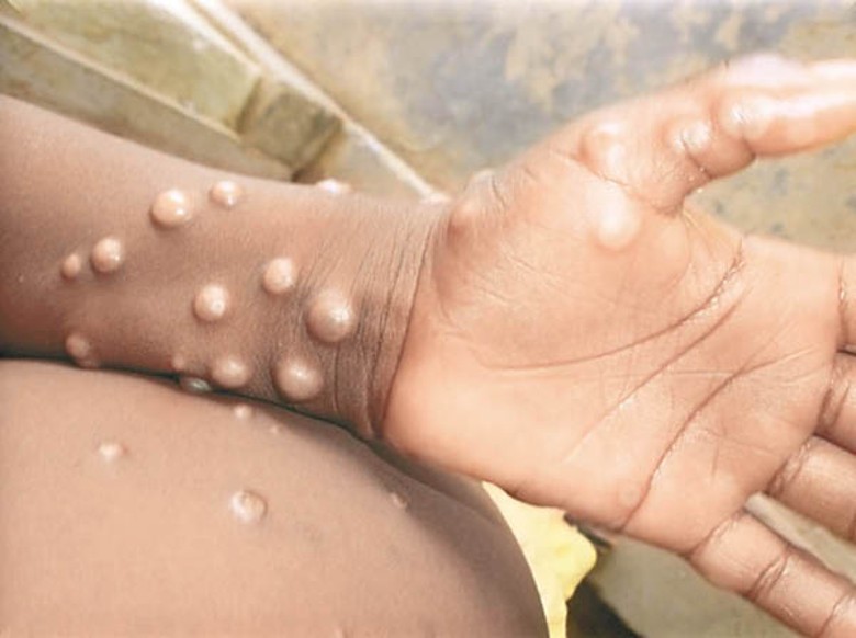 世衞指出，最近有迹象表明部分地區的猴痘疫情正在減緩。
