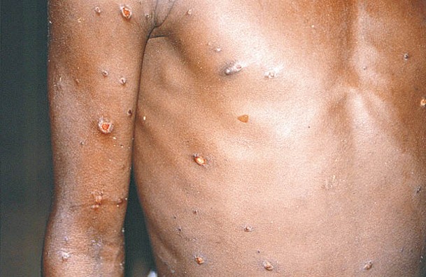 感染猴痘出皮疹。