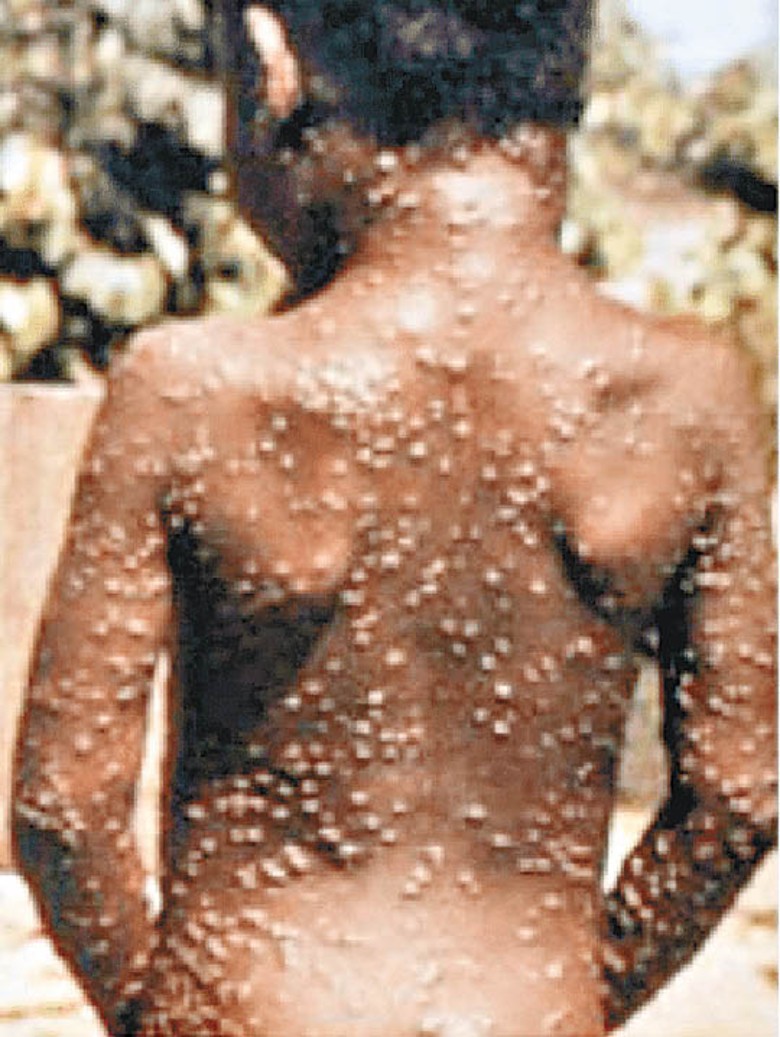 猴痘傳播途徑廣泛。