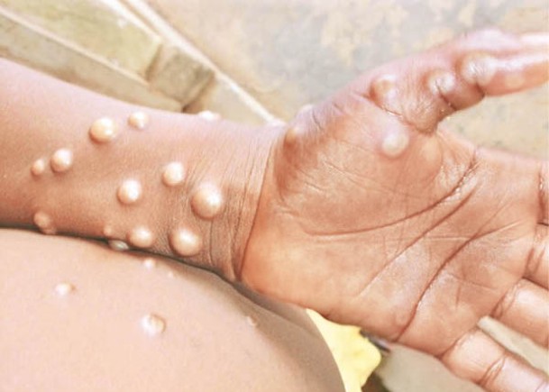預留西貢戶外康樂中心  儲藥物疫苗  處理猴痘