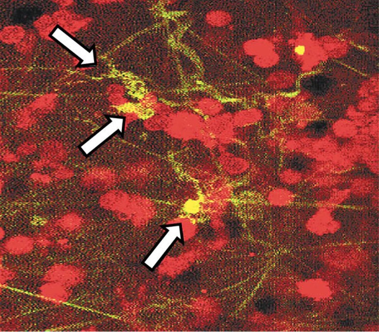 巨噬細胞轉化的神經元樣細胞（紅色範圍）在肺腫瘤樣本中傳遞信號（箭嘴示）。
