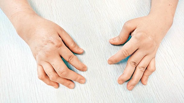 類風濕關節炎病情嚴重，可致手指變形。