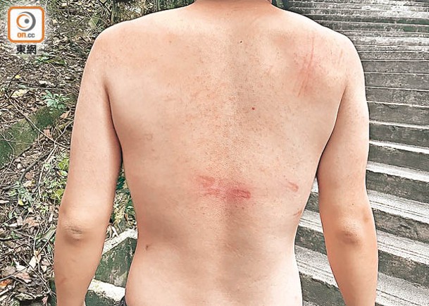陳向記者展示身上多處傷痕，背部留有多處大面積疤痕。