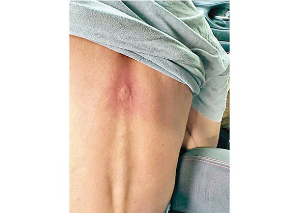 野蜂螫傷處或會出現紅腫刺痛。