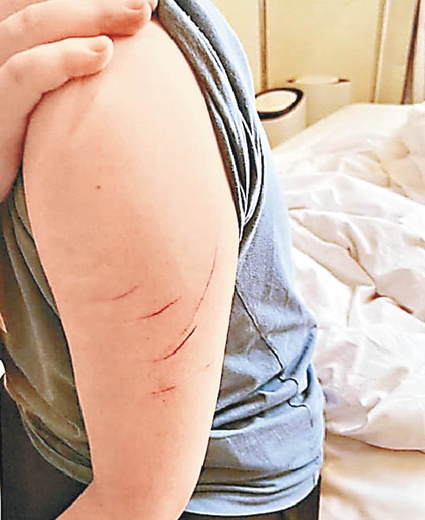 女事主手臂留下自製綁架案的傷痕。