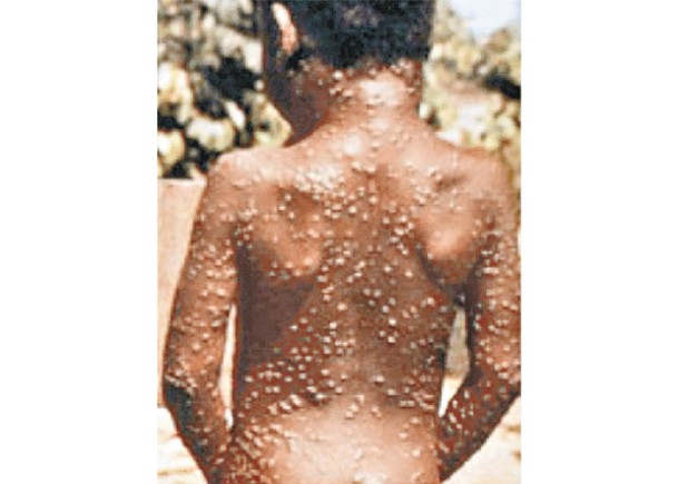 本港近日錄得的猴痘確診個案呈現顯著上升。