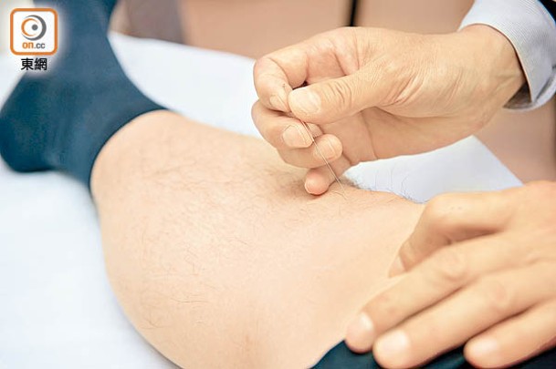 針灸是其中一種治療膝關節炎的方法。