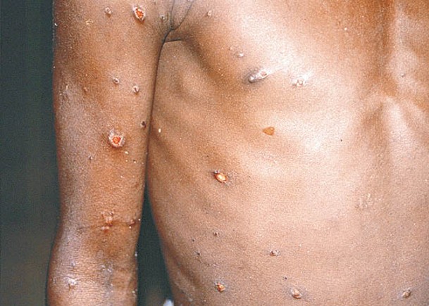 飛沫傷口  可傳猴痘  感染風險男女都有