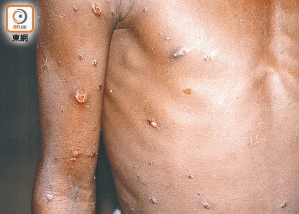 本港至今共錄得50宗猴痘確診個案。