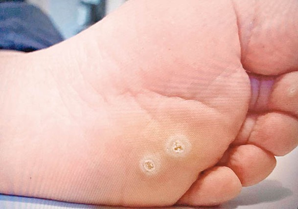 疣最常出現於患者的手掌、腳趾附近。
