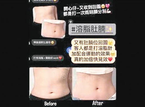 有消脂宣傳展示女性腰部的前後對比照。