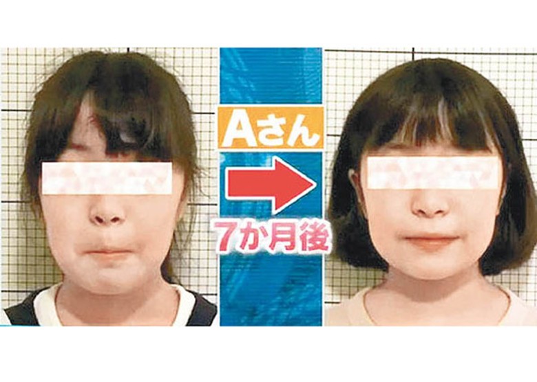長期戴口罩影響兒童身心健康，日本有女生面相受影響。