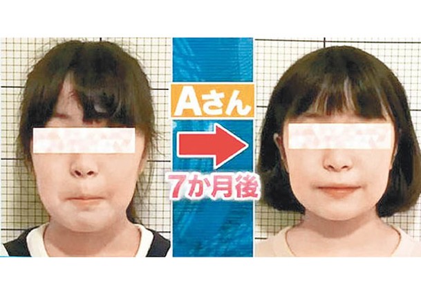 長期戴口罩影響兒童身心健康，日本有女生面相受影響。