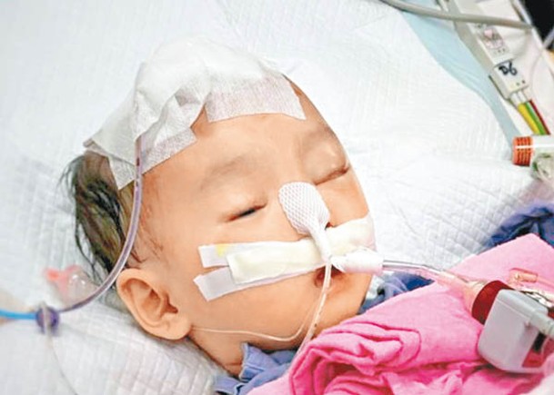 9個月大女嬰小雪兒腦部有血塊，疑遭社區女保母不恰當對待。