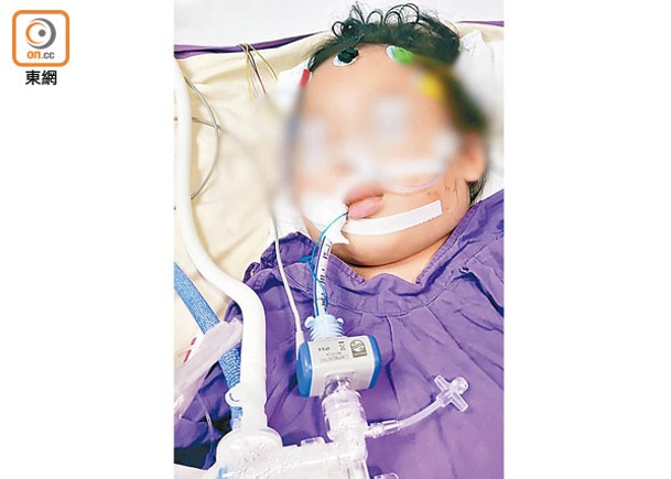 4歲女縫針心臟驟停  DNA證無關病情