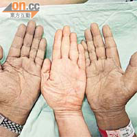 老夫婦送院時手掌呈紫黑色（左及右）。	（本報台中傳真）