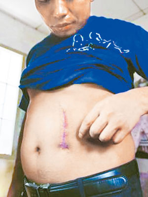 浙江賣腎者展示腹部的手術疤痕。（資料圖片）