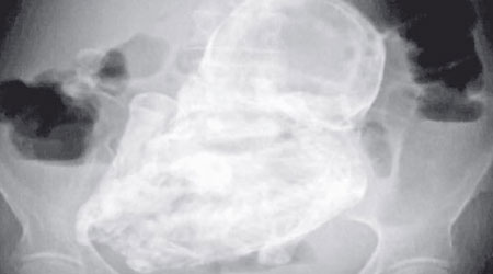 X光片中可見老婦腹中的石胎。（互聯網圖片）