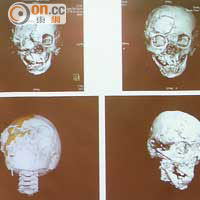 院方利用3D打印科技為楊雲盈重建眼眶骨。