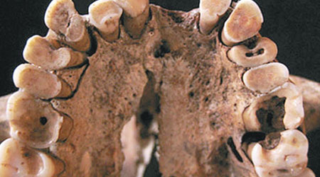 骸骨顯示，摩洛哥的前農業社會古人類蛀牙嚴重。（互聯網圖片）