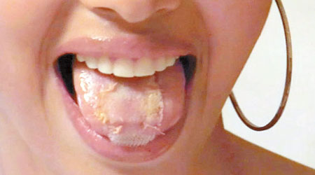 納瓦在舌頭縫上塑膠網，減少進食以瘦身。（互聯網圖片）