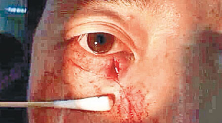 遇襲護士臉部被玻璃碎劃傷。（互聯網圖片）