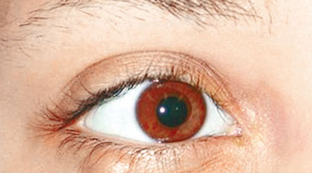 霰粒腫會令瞼皮隆起。（互聯網圖片）