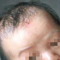 男嬰在接種疫苗後皮膚出疹。（互聯網圖片）