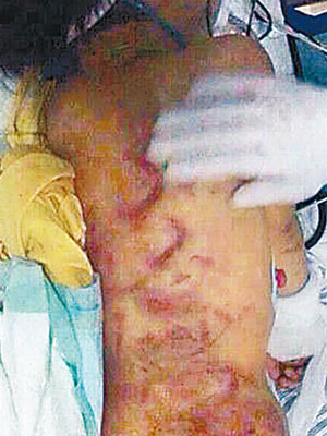 女童遍體鱗傷，背部有多條紅痕。（互聯網圖片）