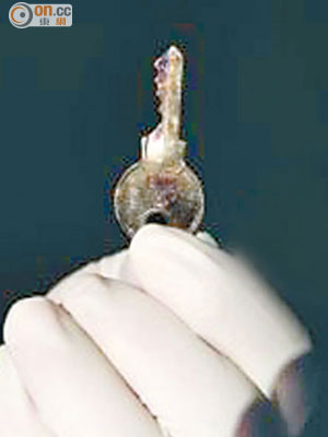 小李吞下的鎖匙有五厘米長。
