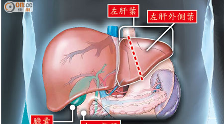 肝臟移植解構<br>一般而言，移植肝臟是切除捐贈者左肝葉，再換至受捐者身上。倘受捐者是兒童，例如是次肖體政的案例，則只需移植左肝外側葉便可。
