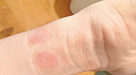 有用戶稱戴上Apple Watch後出現皮疹。（互聯網圖片）