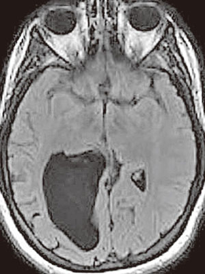 科恩腦部有一個檸檬般大的洞（黑色處）。（互聯網圖片）