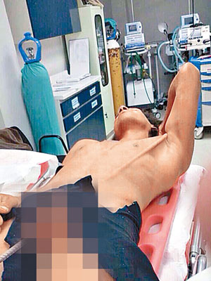鋼筋由男子的下體延伸到左邊腋下。（互聯網圖片）