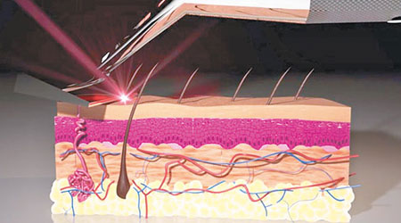Skarp Razor以雷射技術「切斷」毛髮，不會傷及皮膚。