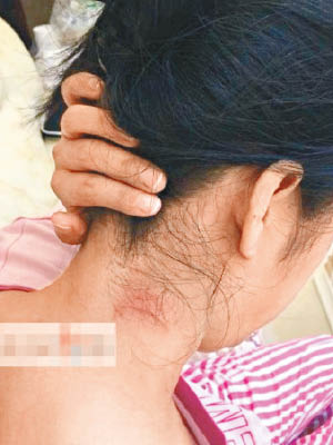 李女反抗期間後頸被打傷。