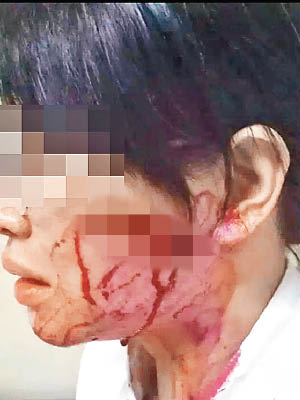 護士臉上有多處刀傷。（互聯網圖片）